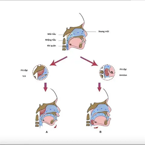 Cá thở bằng miệng: Nguyên nhân và cách xử lý hiệu quả