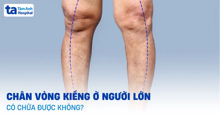 Kiềng Hồ Cá Là Gì? Toàn Tập Về Phụ Kiện Đắc Lực Cho Bể Cá